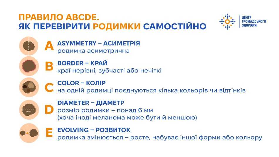 Травень — місяць обізнаності про меланому. Як їй можна запобігти та коли звертатися до лікаря